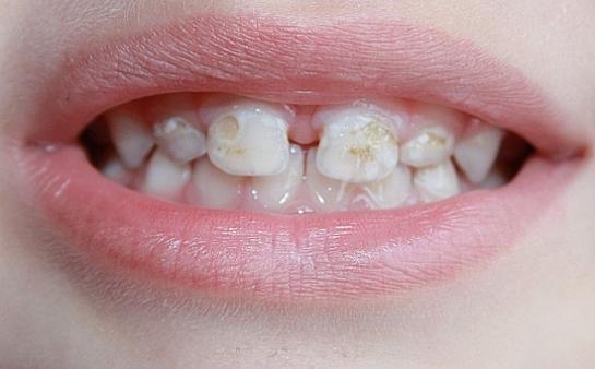 гипоплазия зубов ребенка