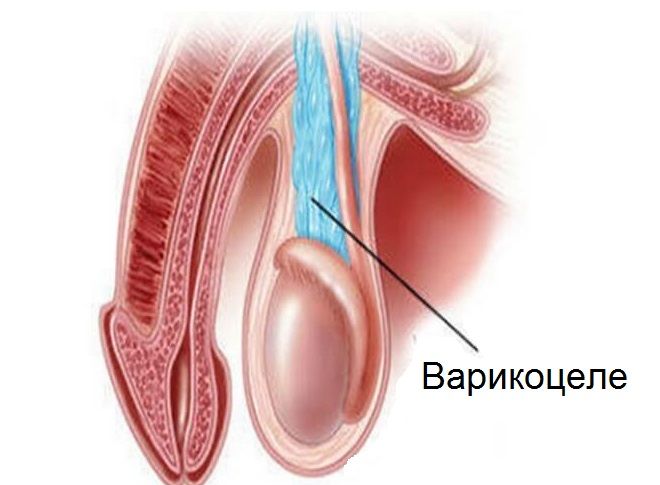 Половой член и яички с варикоцеле